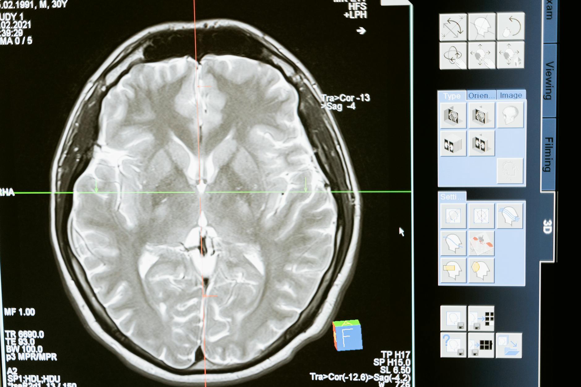 Brain Scan for Depression: A Breakthrough in Psycho-Radiology.
